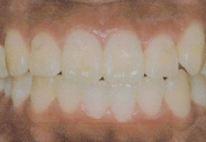 orthodontic_img012